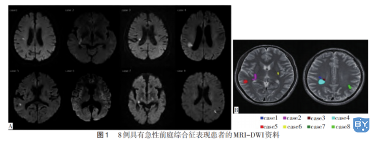 具有急性前庭综合征表现患者的MRI-DWI资料